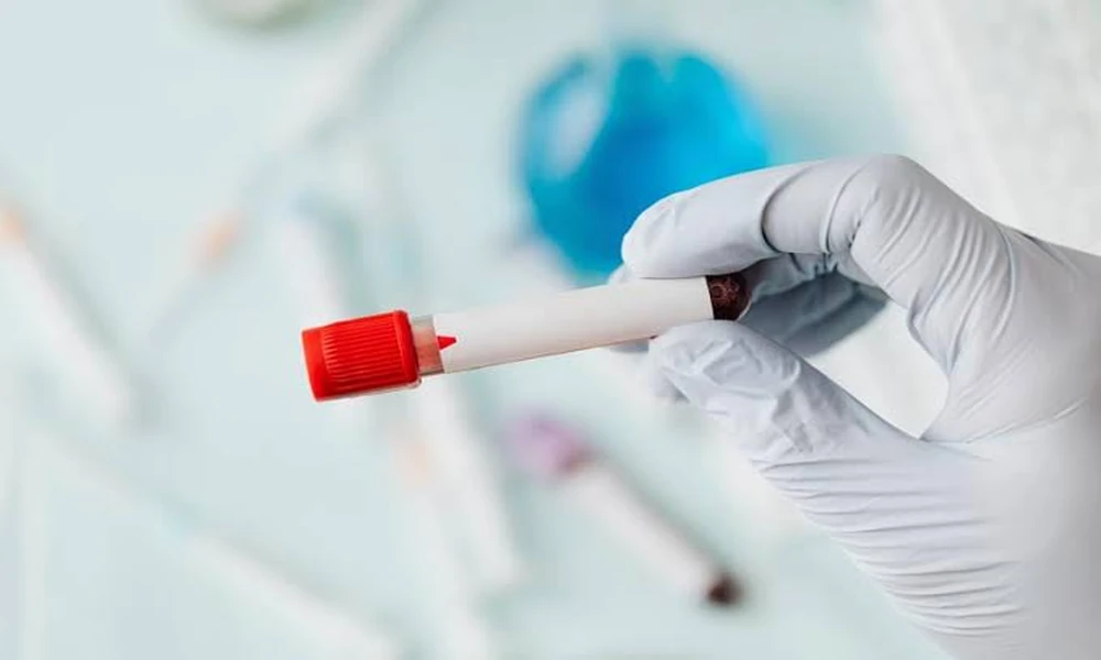 STD Test Preparation Tips for a Smooth Experience