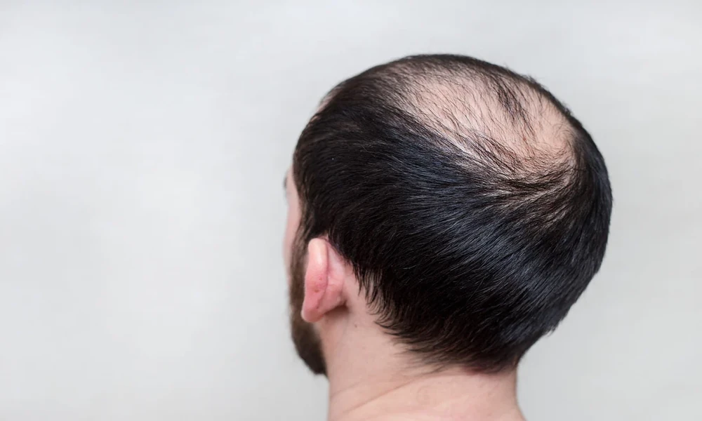 When Hair Loss Needs More Than a New Hair Product